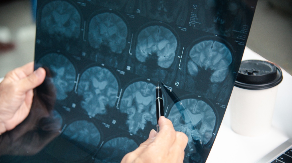 doctor is diagnosing brain problems using x-ray films