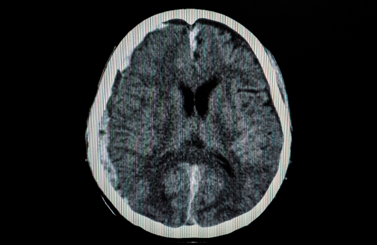 CT scan of a brain