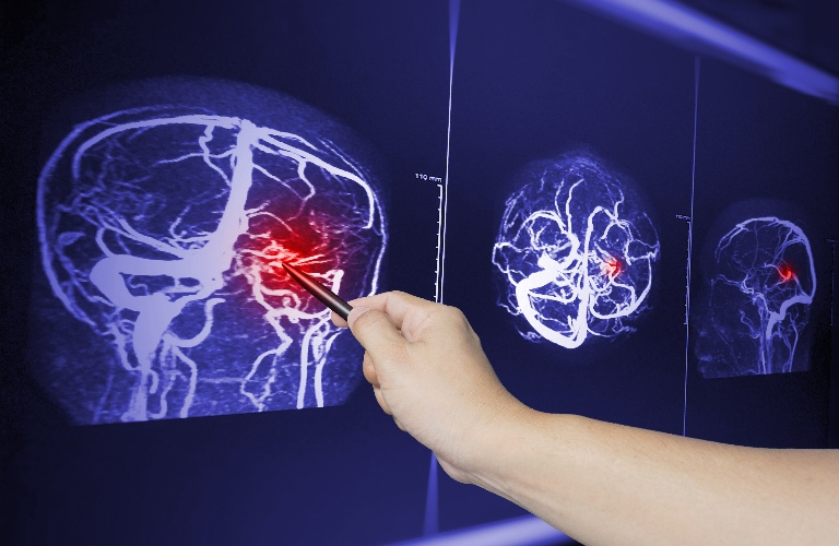 doctor points MRA brain scan image